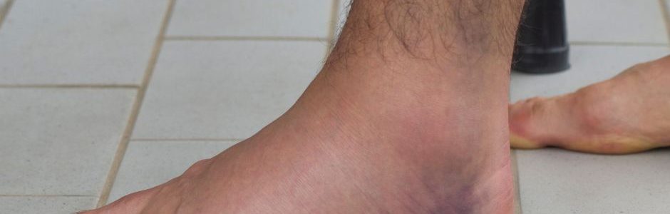 OrthoOIC - sprained ankle treatment Fairfax VA