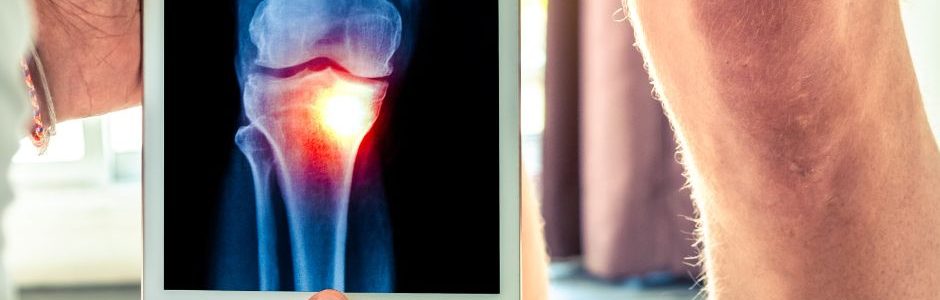 OrthoOIC - urgent care for knee pain relief in Arlington